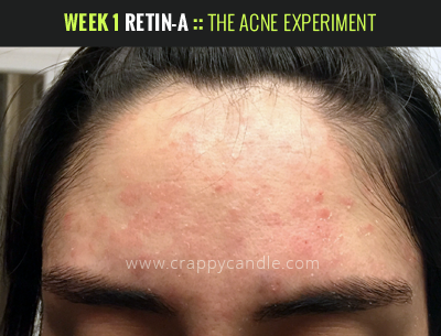6 Month Retin-A Review - The Acne Experiment | Crappy Candle 6 Month Retin-A Review - The Acne Experiment | Crappy Candle