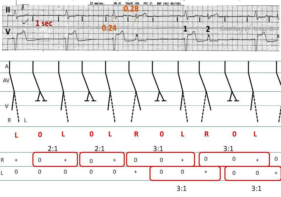 ECG Rhythms Bradycardia with Alternating Bundle Branch Block