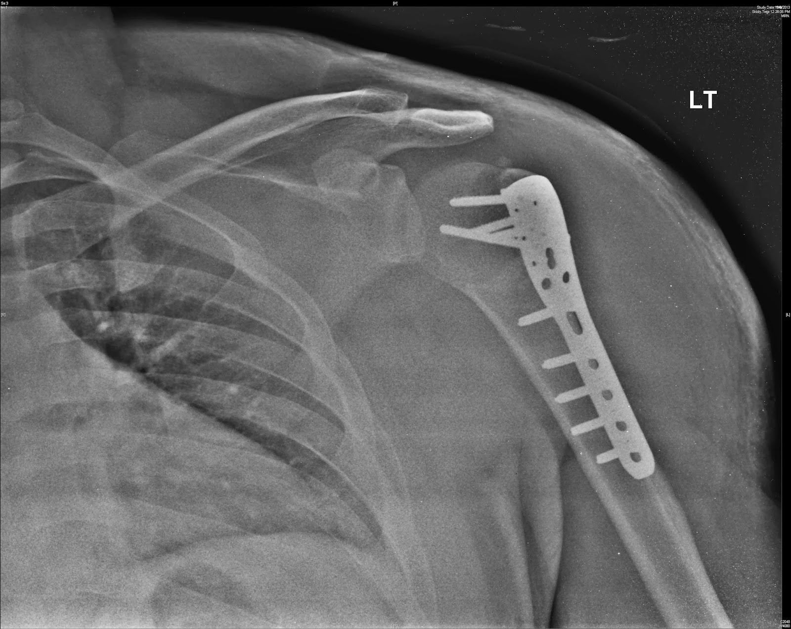 Radiographic Image Of A Spiral Fracture In Humerus Shaft 80A