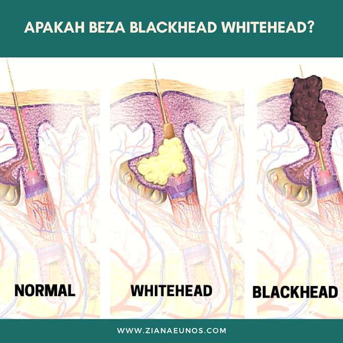 Punca Blackhead Whitehead | Cara Mencegah dan Menghilangkan Blackhead Whitehead