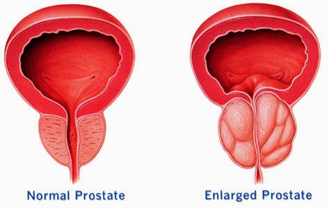 obat alami kanker Prostat stadium 2, obat kanker prostat, pengobatan kanker prostat
