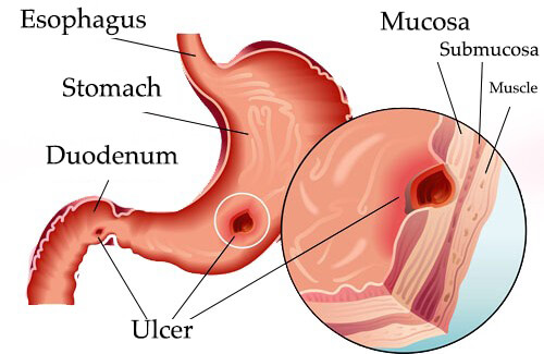 Natural Remedies For Severe Stomach Pain Natural Remedies For Severe Stomach Pain
