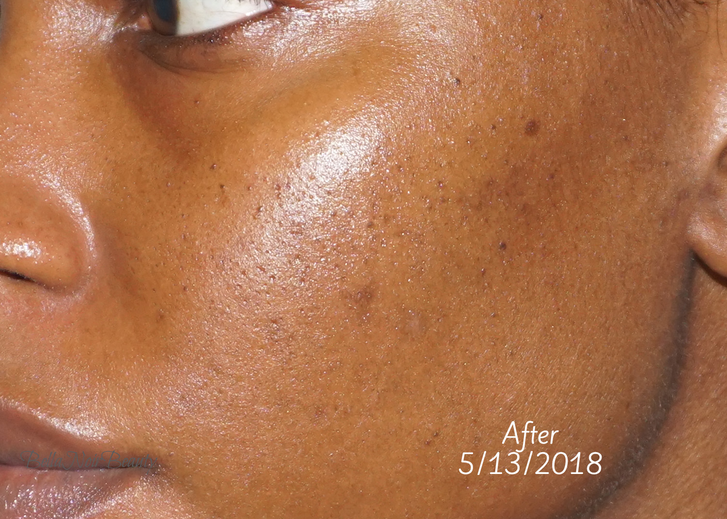 the ordinary mandelic acid acne