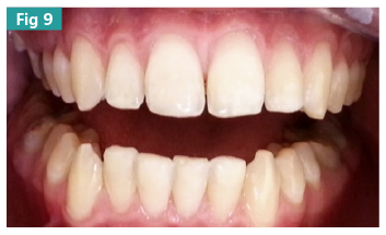 Molar Incisor Hypomineralization (MIH): Conservative Treatment Approach