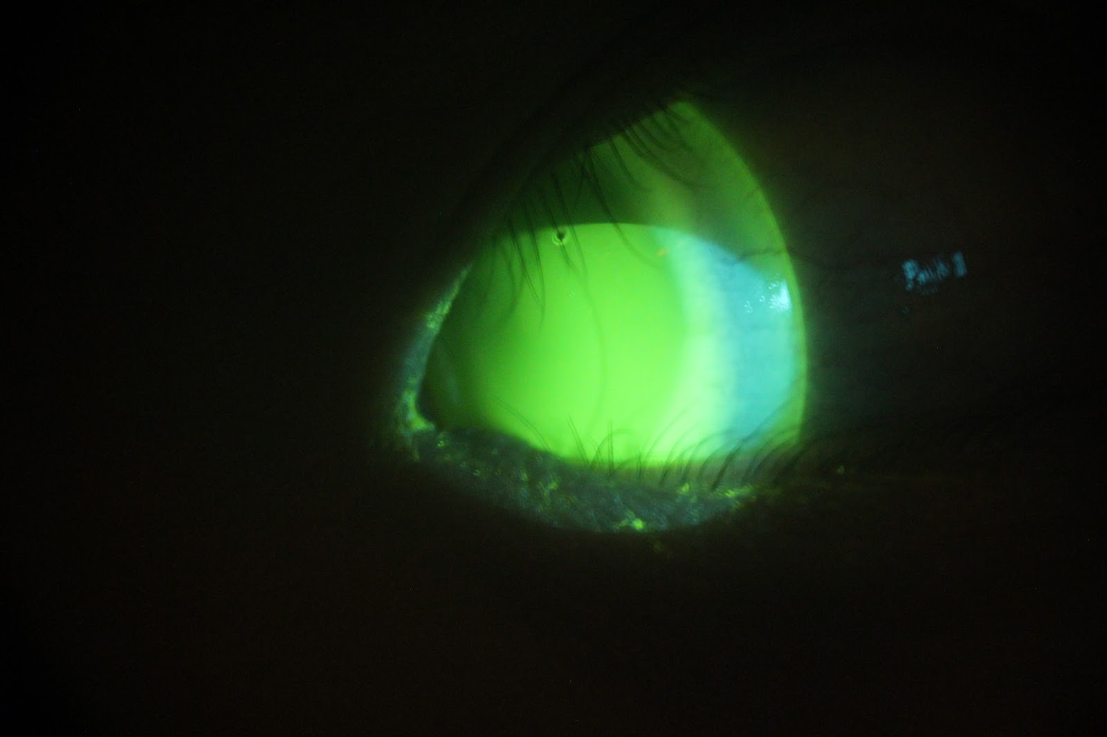 Bubble In Scleral Lenses