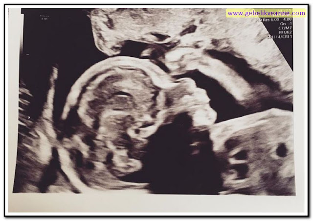 22 Haftalık Gebelik (Hamilelik) Ultrason Görüntüleri