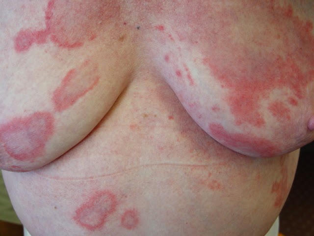 That annular lesion is not necessarily tinea - The ...