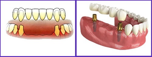 MẤT 3 RĂNG CẦN CẤY BAO NHIÊU TRỤ IMPLANT MẤT 3 RĂNG CẦN CẤY BAO NHIÊU TRỤ IMPLANT