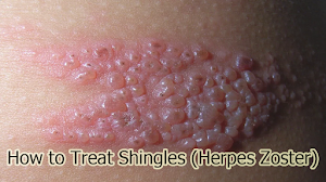 How to Treat Shingles (Herpes Zoster) How to Treat Shingles (Herpes Zoster)