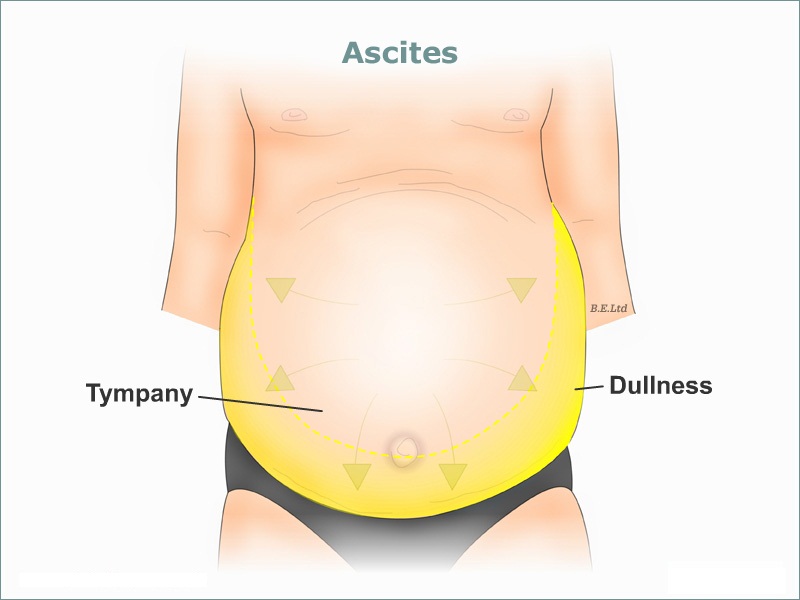 Асцит у плода. Асимметрия живота асцит. Скопилась жидкость в брюшной полости.