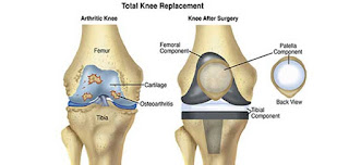 knee replacement in Delhi knee replacement in Delhi