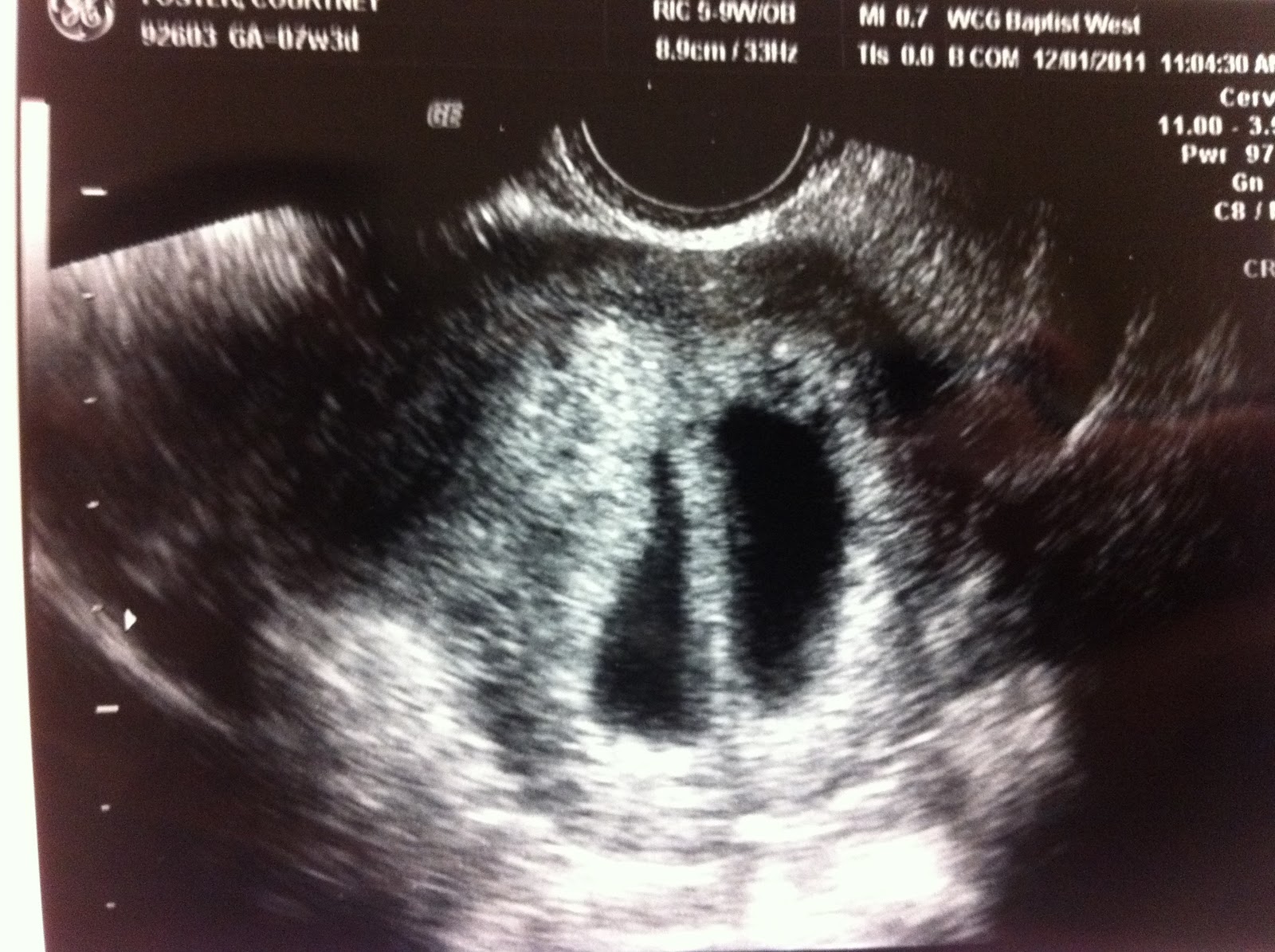 Twin Pregnancy Our first ultrasound