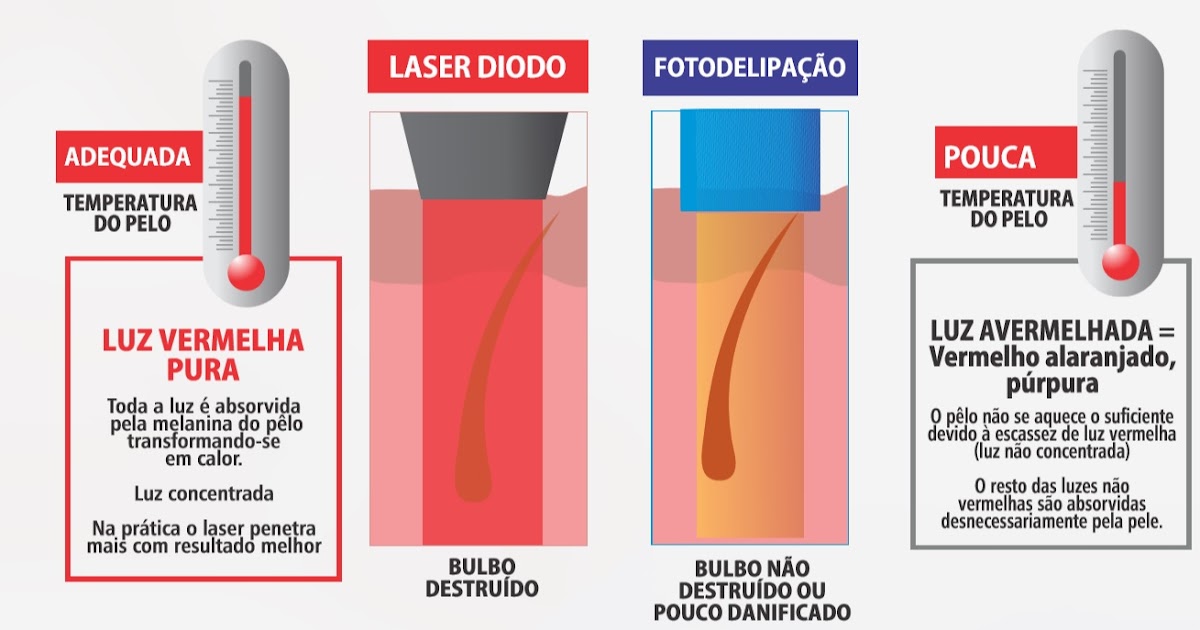 Avaliação Gratuita: Qual é a diferença entre a luz pulsada e o laser?