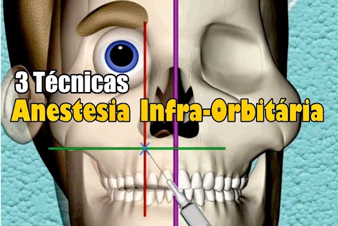 ANESTESIA INFA-ORBITÁRIA - 3 Técnicas