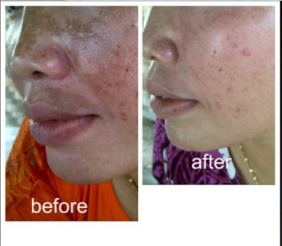 Cream Menyamarkan Noda Hitam Liyoskin Cream Menyamarkan Noda Hitam