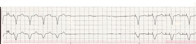 ventricular paced failure to capture ventricular paced failure to capture