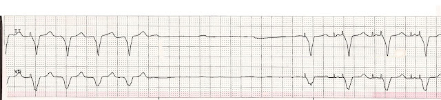 pacemaker failure to capture rhythm strip