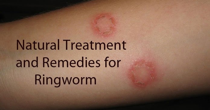 Natural Ringworm Treatment For Cats Natural Ringworm Treatment For Cats