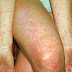 Scabies Infection, Causes and Treatment-gregoryhealthworld