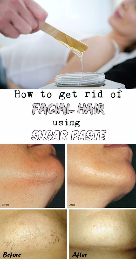 How to get rid of facial hair using sugar paste Health and Beauty