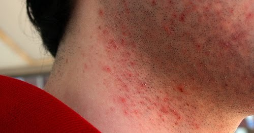 Bollicine rosse nella zona della barba: follicolite o pseudofollicolite ...