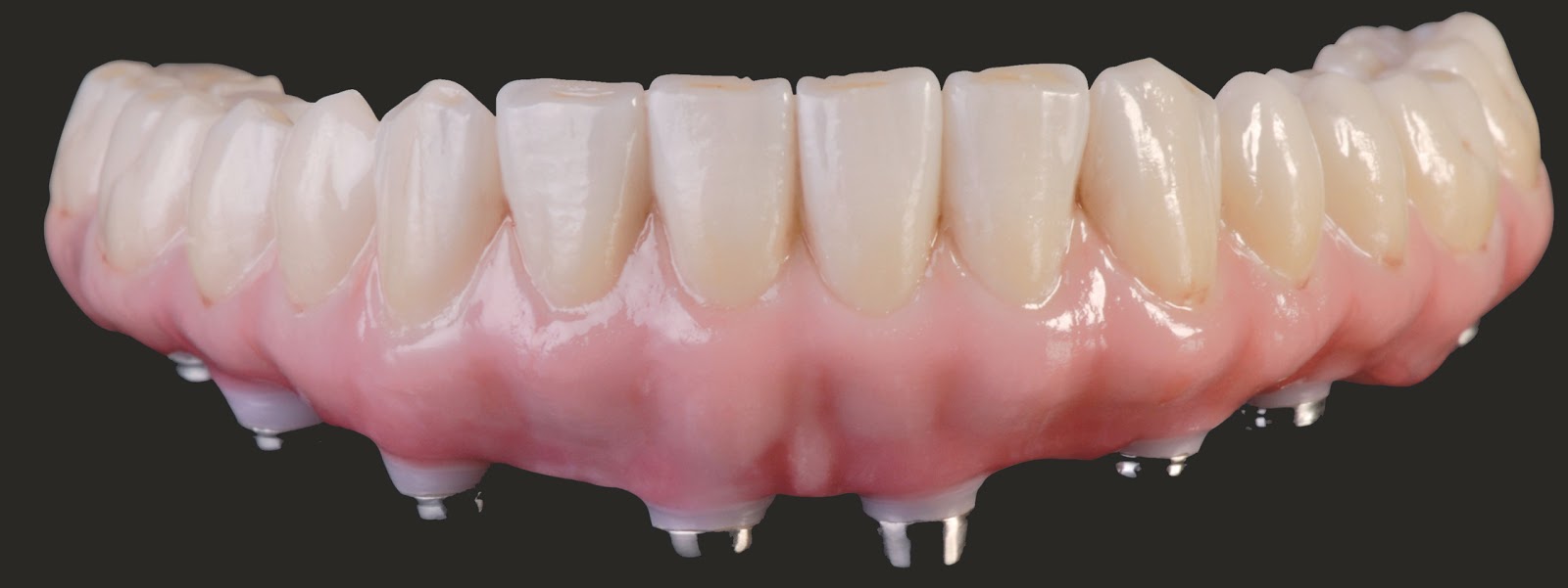 TLZ All Zirconia Crowns & Bridges Expanded Uses Of Zirconia