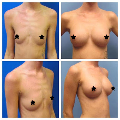 Antes e Depois Mamoplastia de Aumento Antes e Depois Mamoplastia de Aumento