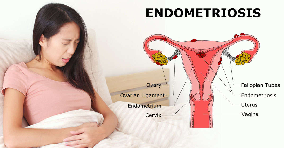 Penyakit Endometriosis dan Kehamilan