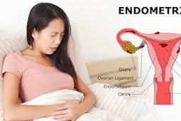 Penyakit Endometriosis dan Kehamilan