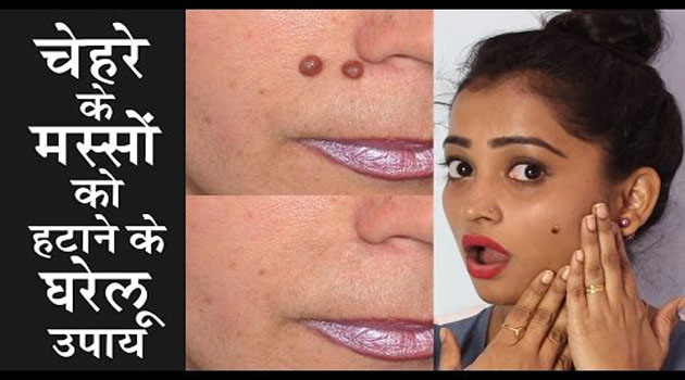चेहरे से तिल और मस्से हटाने के 10 आसान तरीके, How To Get Rid Of Moles चेहरे से तिल और मस्से हटाने के 10 आसान तरीके, How To Get Rid Of Moles