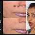 चेहरे से तिल और मस्से हटाने के 10 आसान तरीके, How To Get Rid Of Moles