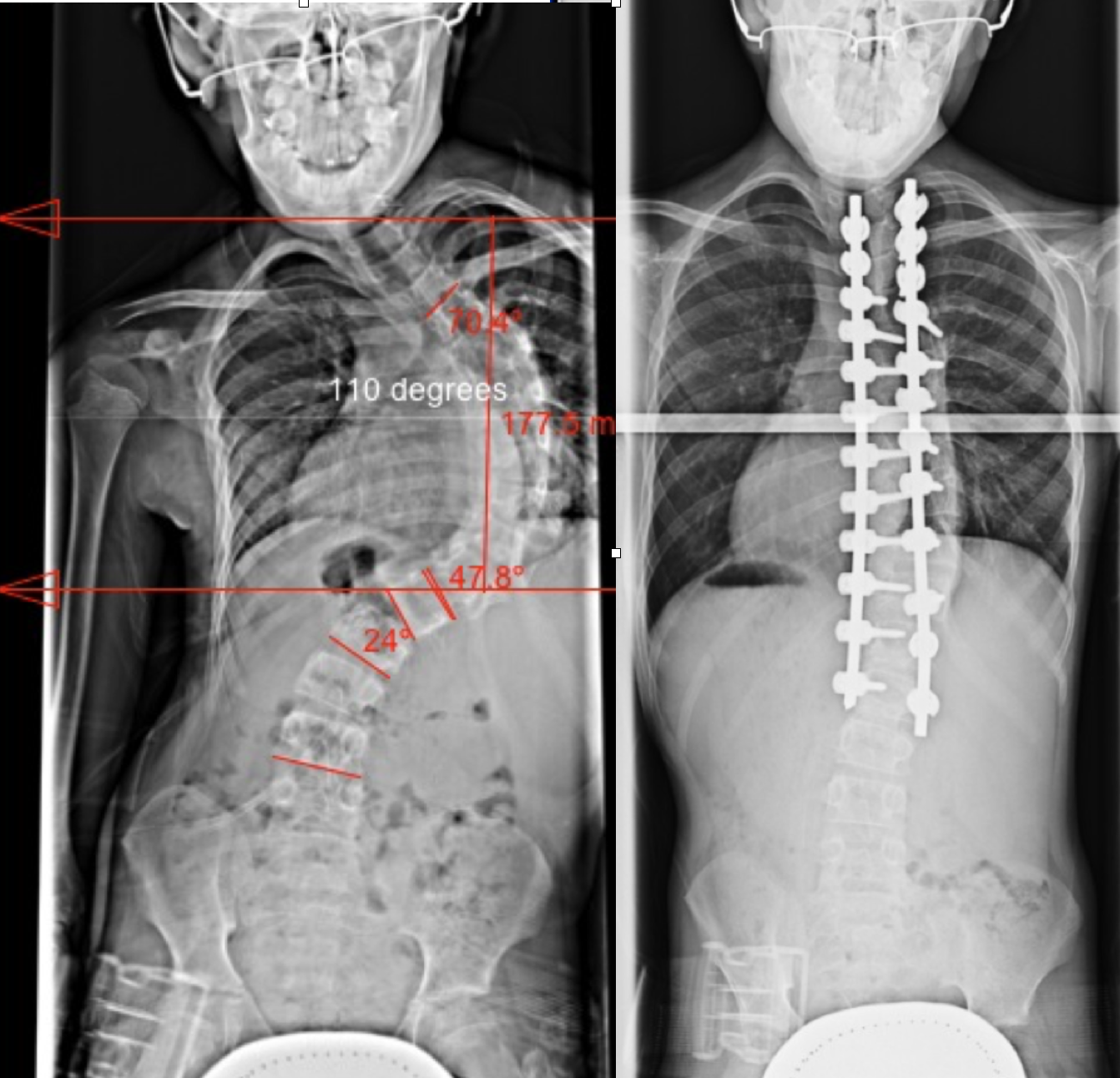 Dr. Lloyd Hey's Blog Hey Clinic for Scoliosis and Spine Surgery