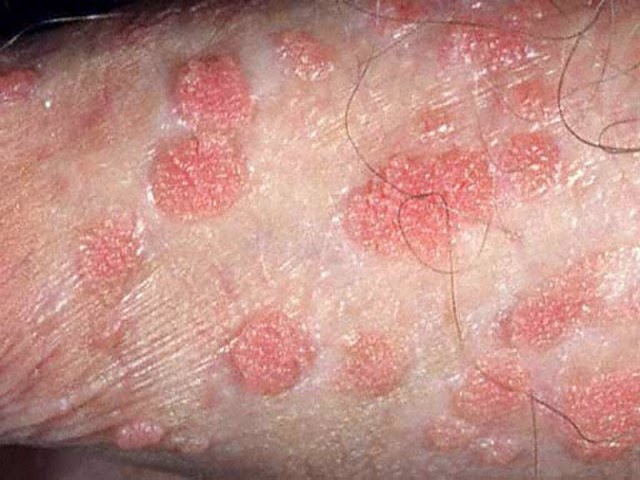 “Herpes Signs and Symptoms,” American Sexual Health ...