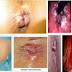 Obat Anti Wasir Antihemoroid Terbaru 2015 thumbnail