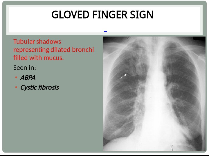 Chest Medicine Made EasyDr Deepu Gloved finger sign