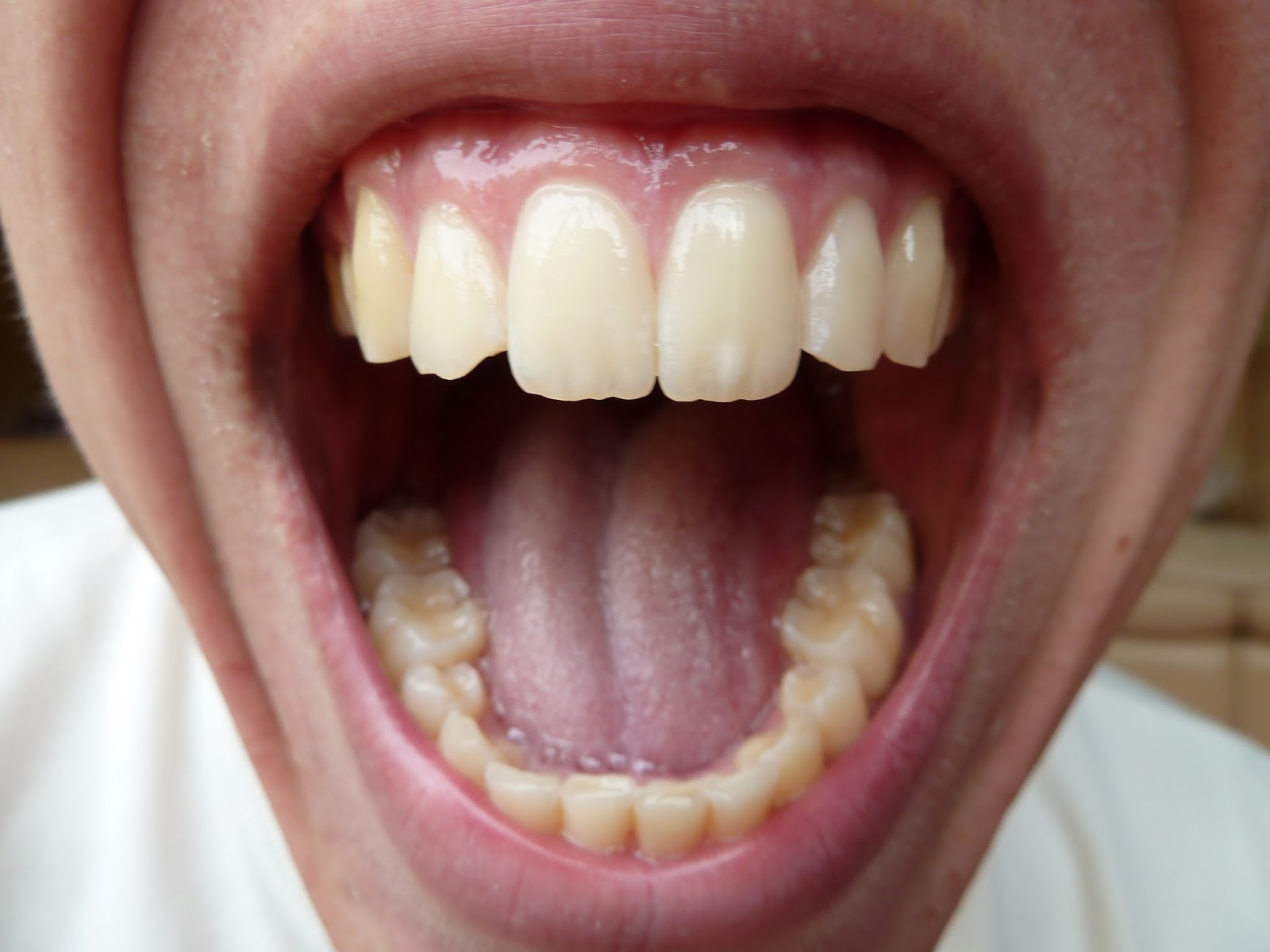 someone-else-s-story-of-braces