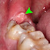 Bạn đã biết đau răng khôn sưng lợi nguy hiểm ra sao?