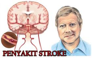 Kenali Tanda Serangan Awal Stroke