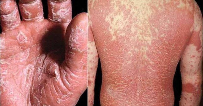 Sou a dermatite atopic
