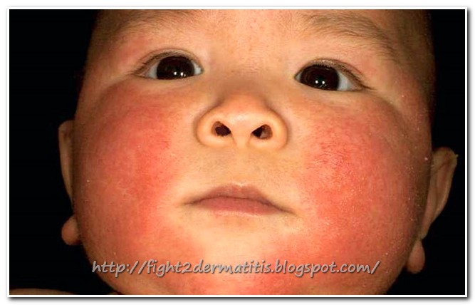 All About Dermatitis in Babies | Let us Fight To DERMATITIS