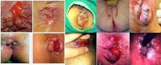 Buang Air Besar Berdarah Pada Anak Buang Air Besar Berdarah Pada Anak