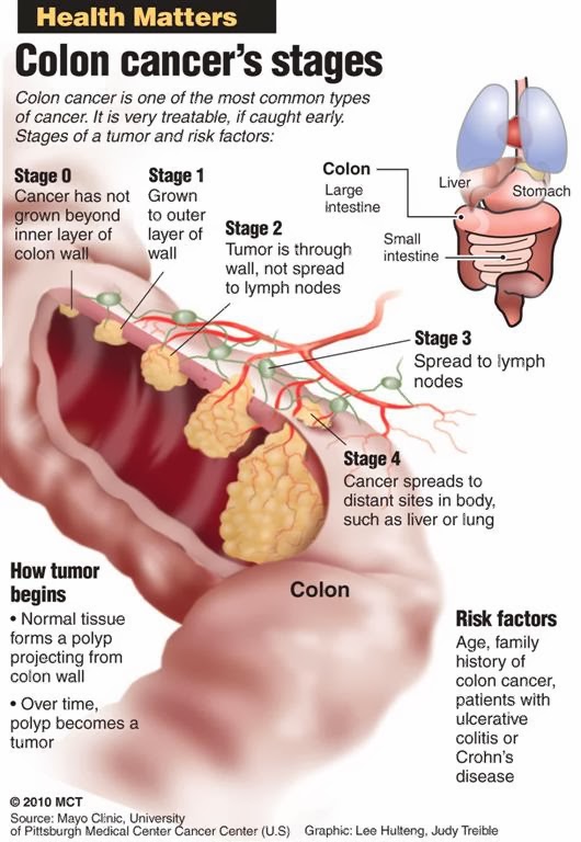 rectal cancer tumor size