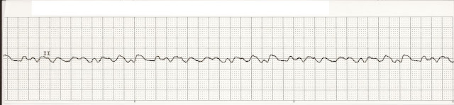 a fib vs a flutter