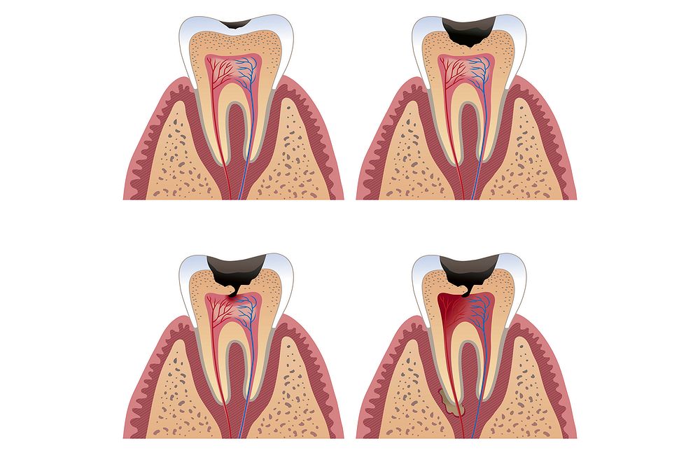 How to Avoid Tooth Nerve Damage Directorio Odontológico