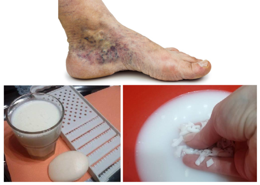 thromboflebits varicoza foot tratament)