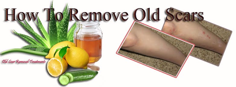 How To Remove Old Scars