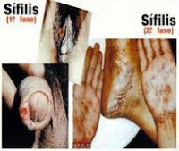 Obat Sipilis Di Apotik Anjuran Dokter Kelamin Obat Sipilis Di Apotik Anjuran Dokter Kelamin