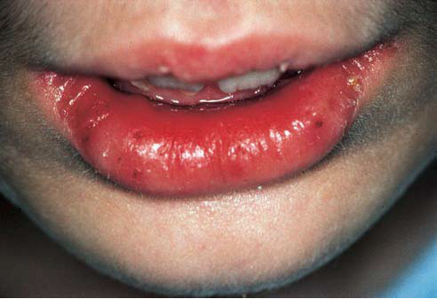 lesions on lips #10