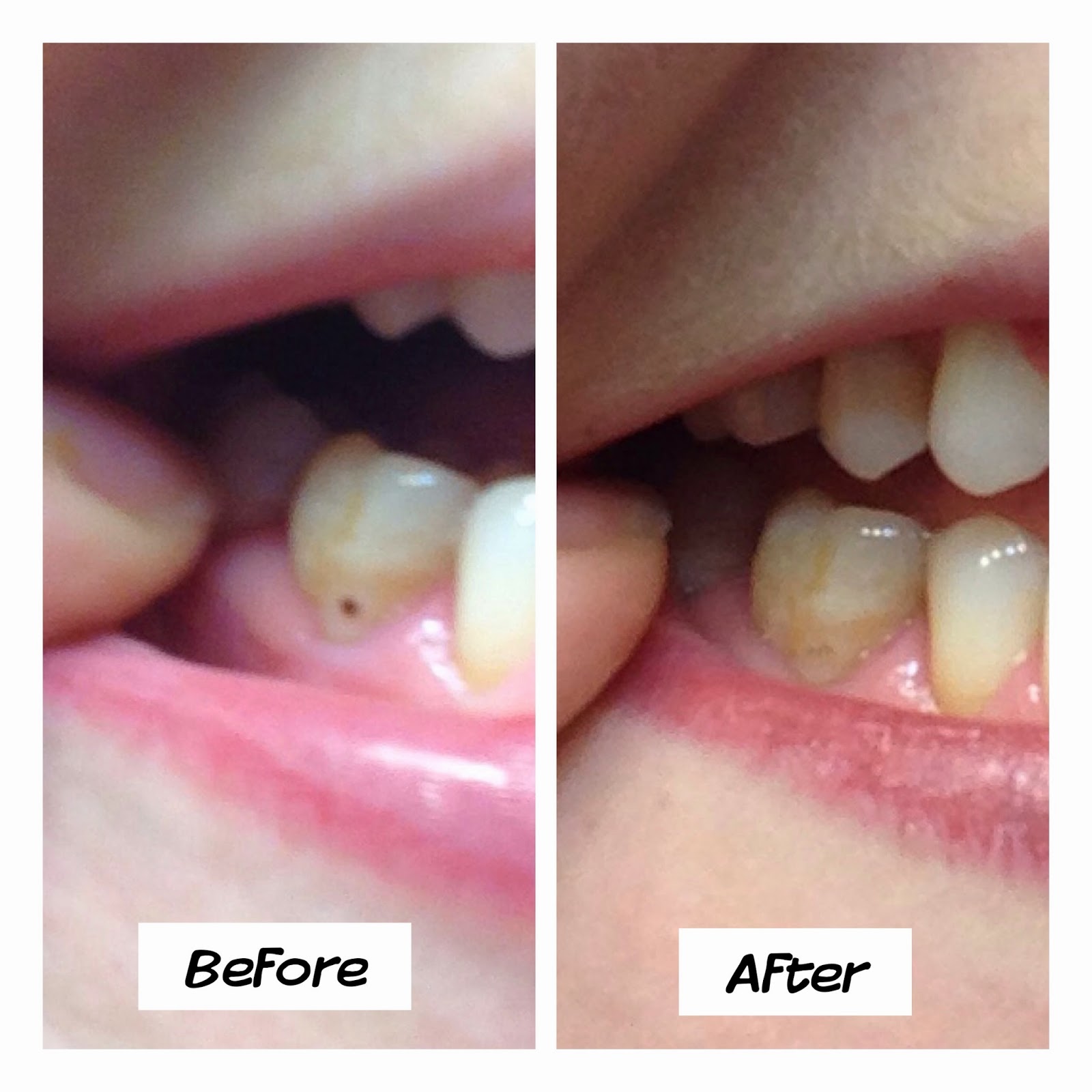 cavity toothpaste naturally cavities tooth rid teeth oil healthy oils filling got essential brooke michael update dentist natural having thieves