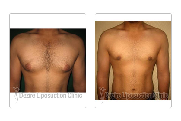 vaser breast reduction Vaser breast reduction